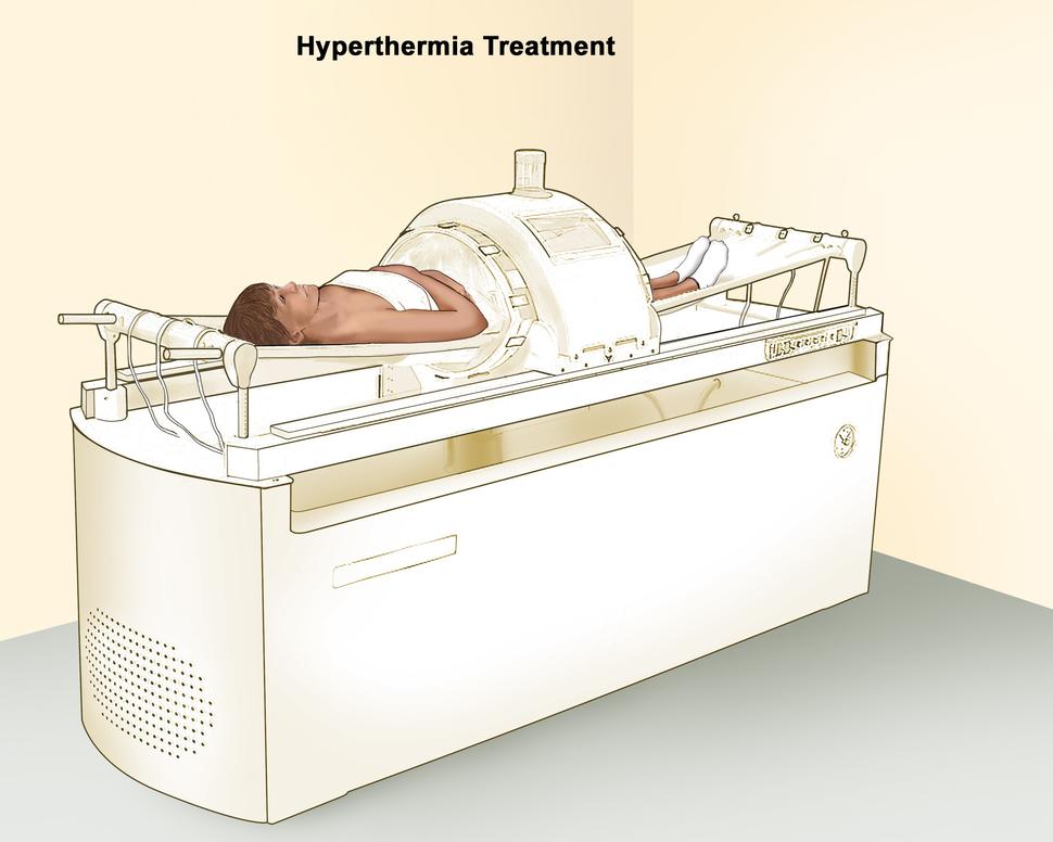 از افزایش دما تا درمان سرطان (Hyperthermia)